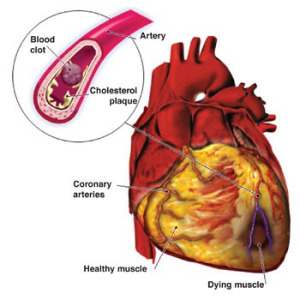 Cardiovascular.Disease6